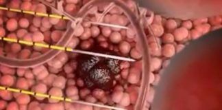 Δράμα, Σέρρες και Κιλκίς «θερίζει» ο καρκίνος