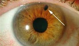 Έρευνα του «ΕΛ.ΚΕ.Θ.Ο.Π» του Δ.Π.Θ. για το γλαύκωμα