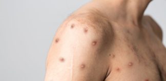 ΕΟΔΥ για ιό ευλογιάς των πιθήκων: 69 κρούσματα όλοι άνδρες με μέση ηλικία 36 έτη